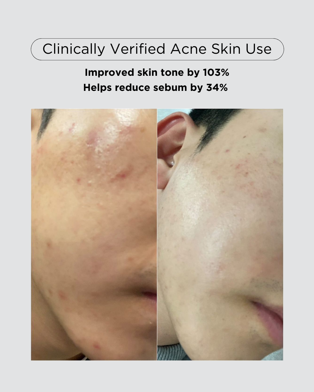 [PROMO] PINKWONDER Tamanu Hero Ampoule